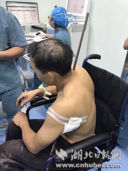 钢筋插入患者身体