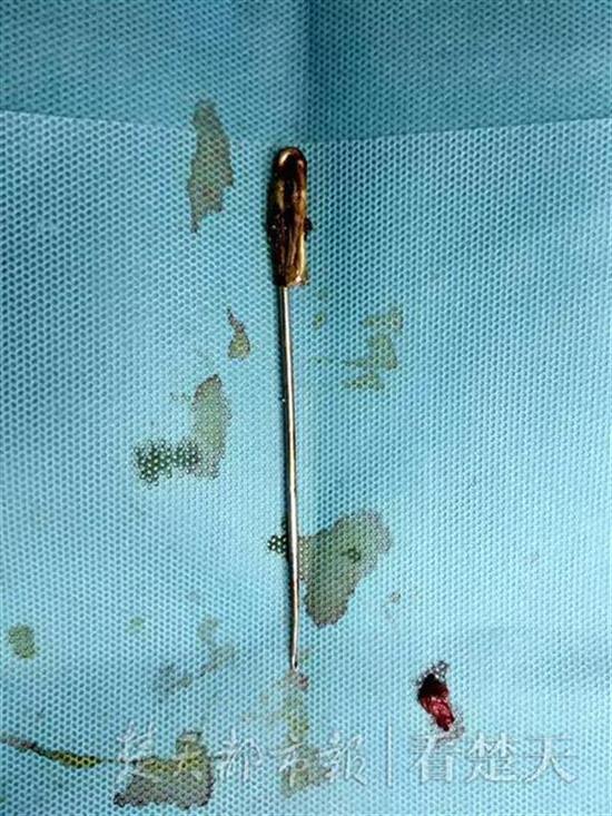 原標(biāo)題：與妻子拌嘴后情緒激動(dòng)，男子一氣之下吞16厘米長(zhǎng)針