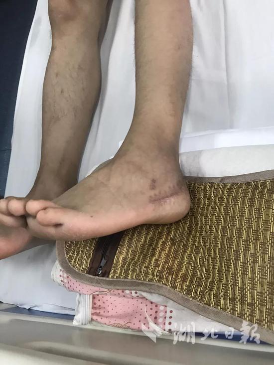 ▲尹文杰在部队受伤留下的疤痕