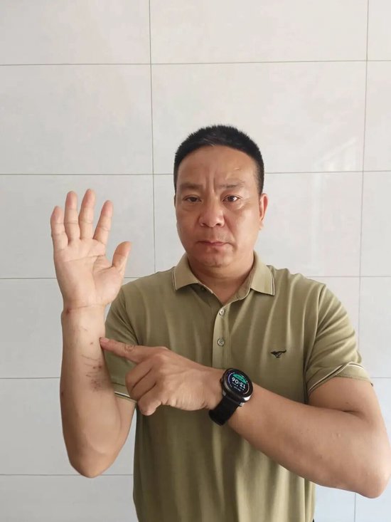 熊唐辉胳膊上的伤口刚愈合。（通讯员郑鉴峰拍摄）