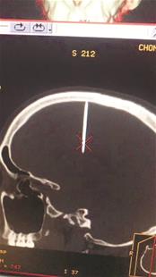 CT片显示，胡师傅的右额颅内有根钉子