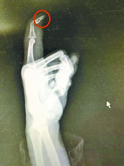 刘先生手指的肌肉已经坏死萎缩并发黑，最终只能截掉这部分手指
