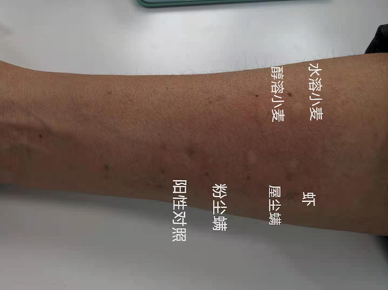 皮肤点刺试验