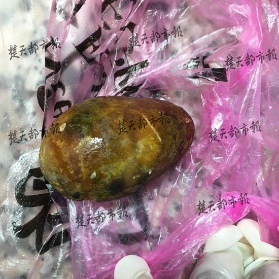 把柿子当饭吃撑破肠子 医生手术掏出鹅蛋大粪石