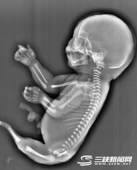 图为人鱼宝宝X光片。 由市妇幼保健院提供