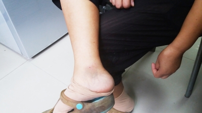 小区保洁员李平先右脚被咬。 记者杨荣峰 摄