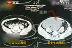 男子腹部隆起似懷孕：體內(nèi)居然有4個(gè)腎