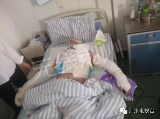 荆州7工人吃火锅遇酒精爆炸 瞬间变火人均被烧伤