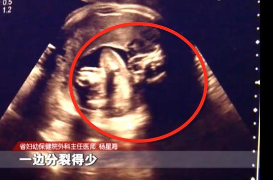武汉一女子产下罕见胎中胎