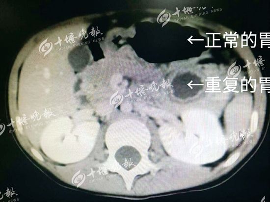 5岁女孩天生长了两个胃