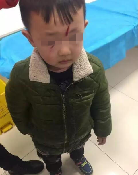 鄂州一幼儿园内小孩被撞伤 额头开花伤口长达