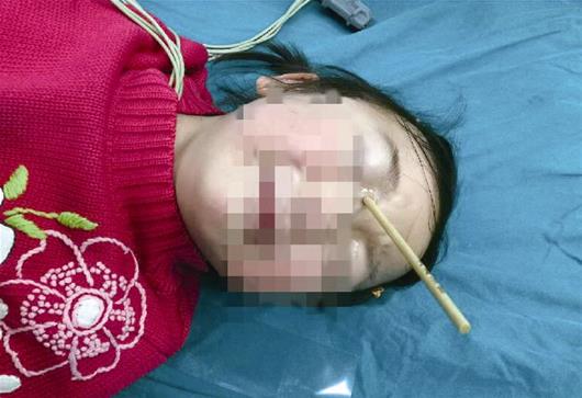 玩耍不慎摔倒 竹签刺进女童右眼角6厘米