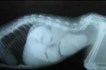 22岁男子腹部超足月产妇 十院救治罕见巨结肠患者