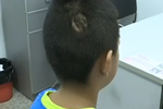 受了傷摸兔子不洗手 湖北武漢一男孩成“瘌痢頭”