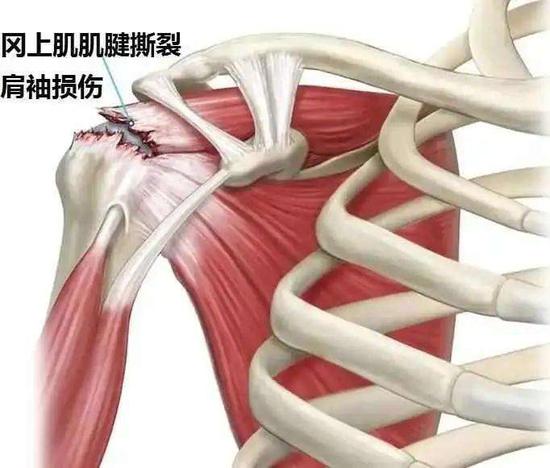 肩袖损伤(冈上肌断裂)示意图