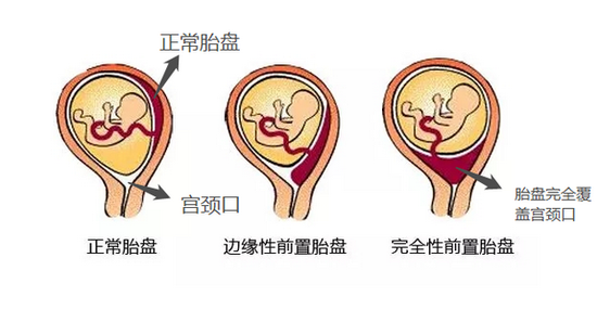 ▲前置胎盘示意图