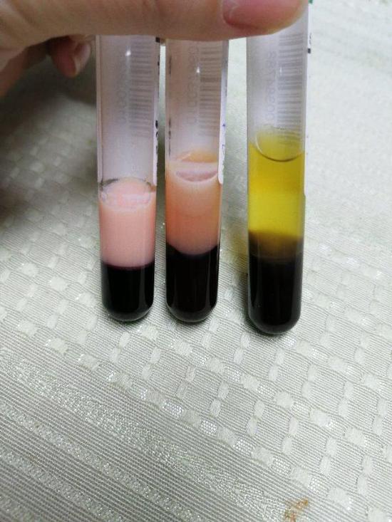 图片说明:毛女士之前抽出的“牛奶血”（左）和经过治疗后的正常血液（右）