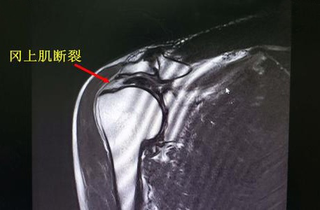 肩袖损伤:冈上肌断裂影像(网络图)