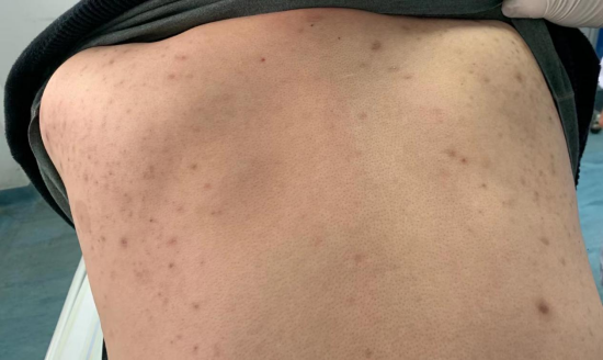夏先生胸背部皮疹照片
