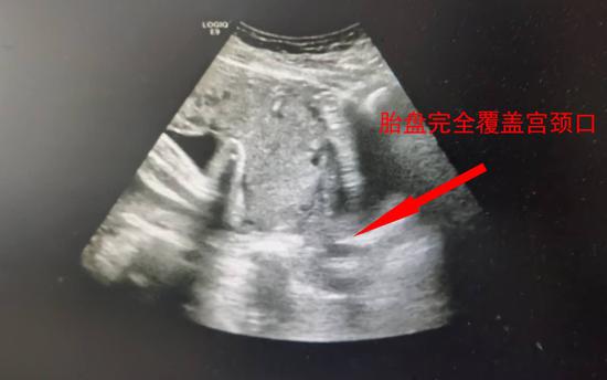 ▲影像显示完全性前置胎盘