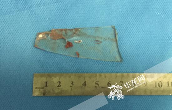 医生手术取出的碎玻璃。 院方供图 华龙网发