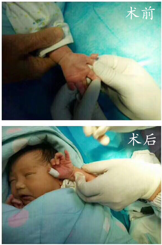 “多指”宝宝在武汉仁爱医院接受手术前后