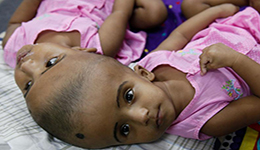 孟加拉国现罕见连头女婴