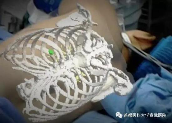（术前胸部CT三维影像与患者本体重合，绿色结节为病灶）