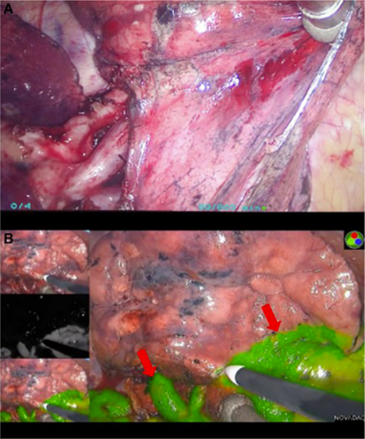 　　图1. 吲哚菁绿在肺段切除术中用于手术指导。（图A）传统技术难以识别段间平面，但（图B）使用吲哚菁绿（图B中的红色箭头）可更清晰地显示段间平面。