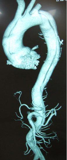 图1：A型主动脉夹层累及全主动脉