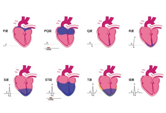 （注：P波，代表心房除极过程；QRS波群，心室除极全过程；ST-T，心室复极全过程；QT间期，整个心室活动过程）