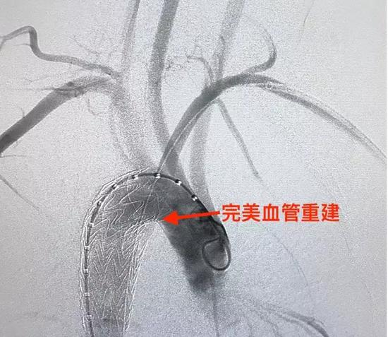 北京医院血管外科完成国内首例罕见主动脉疾病原位开窗修复微创手术