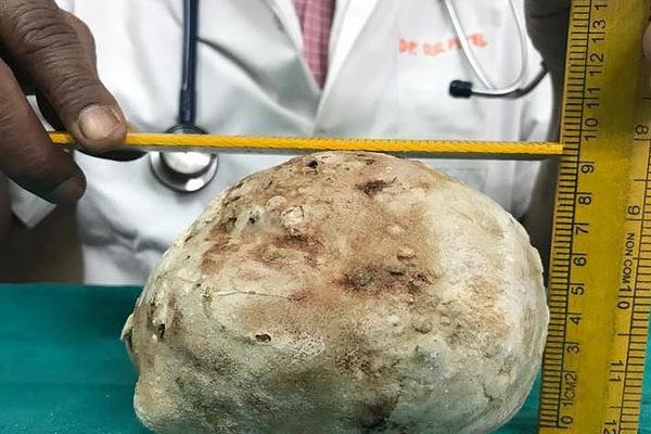  Indian man removes 1.5kg stone from bladder