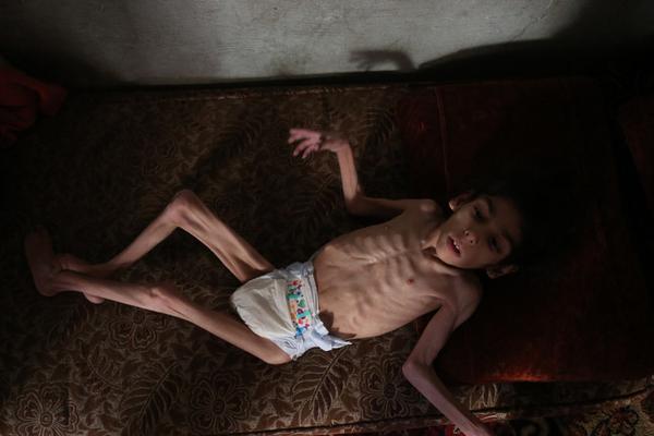  see the scene which is dreadful to one 's mind! Syrian 8-year-old girl is skinny