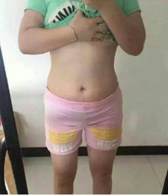 防妊娠纹有综合美腹丽人口碑_妊娠纹图片肚子