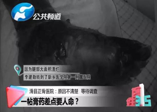 醫生給大爺出的診斷是