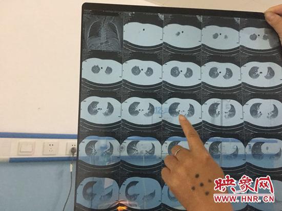 郑某的母亲手拿X光片称,医生说胸腔有积液