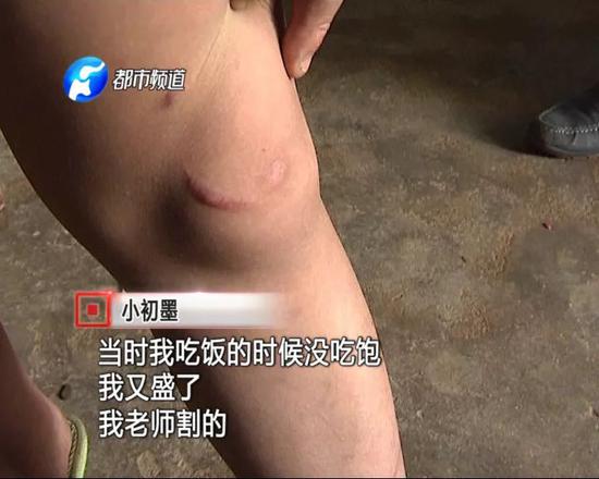 小初墨告訴記者，他身上的傷，都是所謂的馬戲團(tuán)“老師”趙某打的。