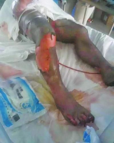 南陽火海救人英雄被燒傷社會捐175萬 黃曉明捐20萬