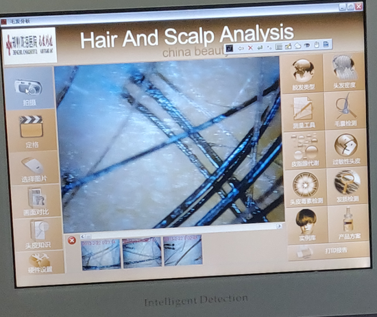 植發男子稱痛到昏迷，“無痛植發”咋會這么疼？