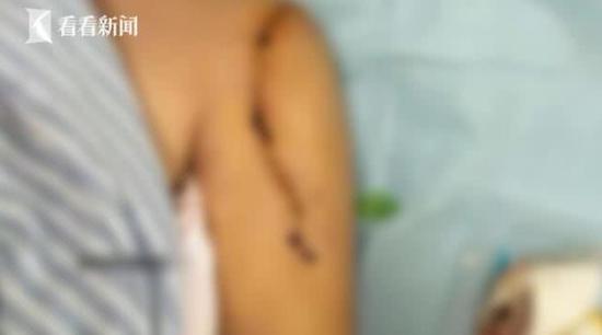 女子做康复训练后被按骨折 竟还被医生嫌娇气