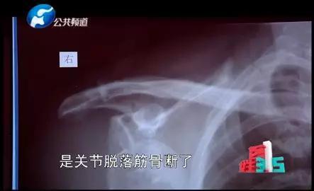 随后,医院给翟老汉做了微创钢钉植入手术。