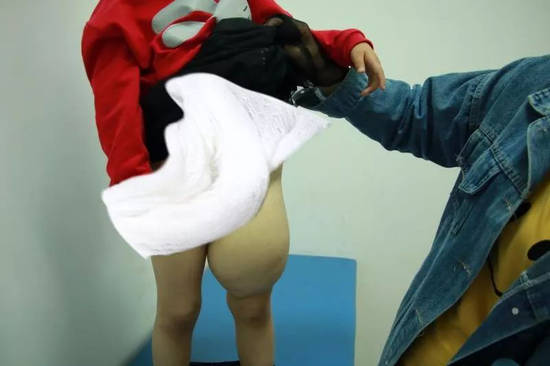 女童出生4年,没穿过裤子,只因左腿比右腿粗三倍