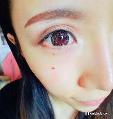 女子多次激光除痣致其癌变