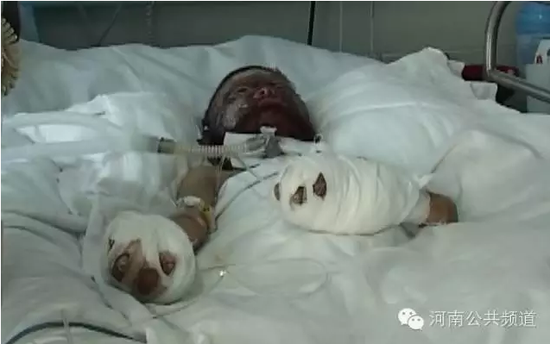 8歲孩子整張臉被燒成黑炭 無錢救治母親幾近崩潰