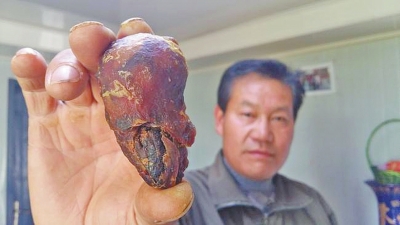 李江友展示从鸡肚子里取出的“肉疙瘩”