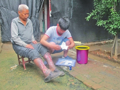 刘伟超每天为父亲消毒换药