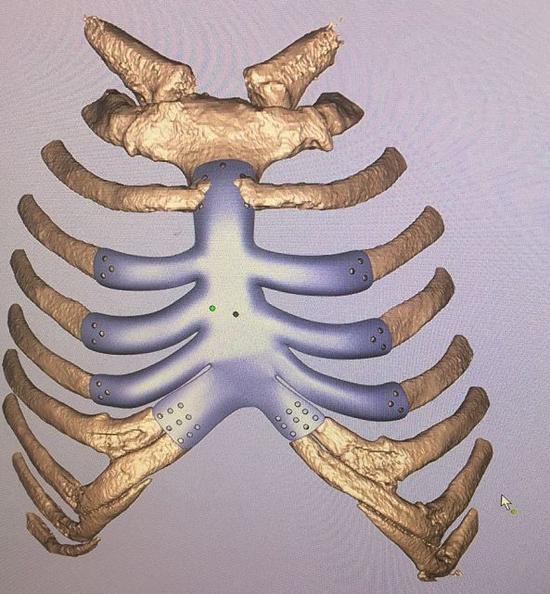 3D打印钛合金胸骨肋骨复合体