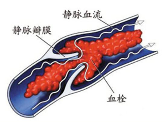 警惕静脉血栓带来的危害