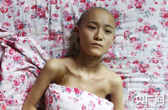 2016年10月26日，四川成都，今年2月，黃文霞被確診為惡性尤文肉瘤，隨后開始了化療。期間，她從長發變成光頭，身體消瘦到只有70斤，疼痛到徹夜難眠，經歷過同房病友的離世……大半年過去了，腫瘤細胞已經在多個臟器發生轉移。 她不想再堅持去醫院治療，而是計劃著一場異國的遠行。“生命后期，我想戴著漂亮的假發，一個人去國外走一走，干點自己想做的事情。”黃文霞說，“地點我已經想好了，韓國或者泰國。”